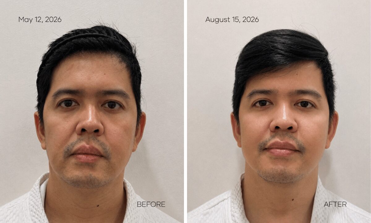 MOLD Manila Shares Three-Month Patient Results From XERF Skin Tightening