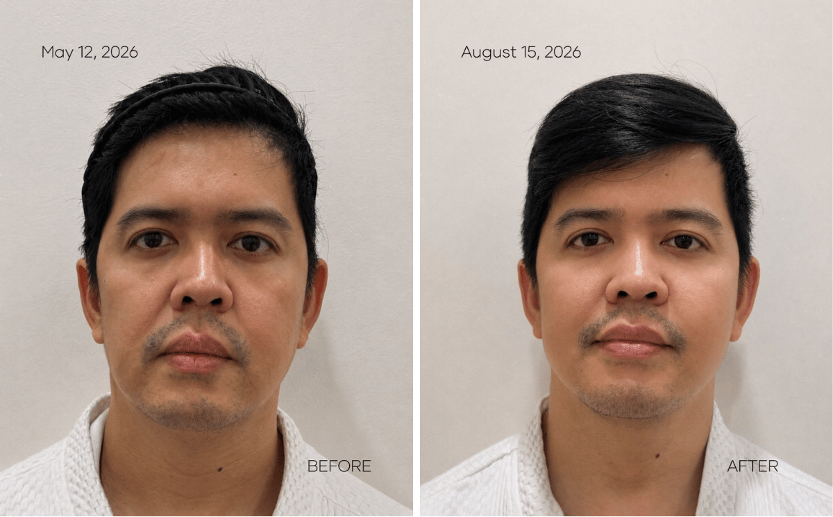 MOLD Manila Shares Three-Month Patient Results From XERF Skin Tightening MOLD Manila Shares Three-Month Patient Results From XERF Skin Tightening